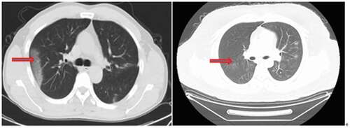 Figure 3. Typical changes in non-contrast enhanced chest CT scan. Multiple peripheral patchy ground-glass opacities with obscure boundary were seen in bilateral multiple lobes. Condensation shadow was observed on the lower right lobe