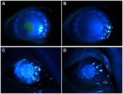 Figure 1 Images of complete healing of corneal epithelia. (A, B) Epithelial healing at 3 and 7 days after surgery in infectious central corneal ulcers; (C, D)epithelial healing at 3 and 7 days after surgery in infectious peripheral corneal ulcers.
