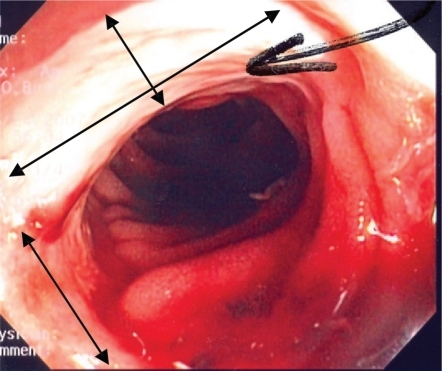 Figure 1 Endoscopic view of the terminal ileum with evidence of large deep serpiginous mucosal ulceration (double headed arrows).