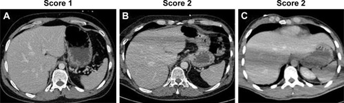 Figure 3 Sample images demonstrating the range of image quality scores in the liver: (A) no artifacts present with excellent image quality (Score 1); (B, C) more pronounced artifacts present than in (A) but with maintained diagnostic image quality (Score 2).