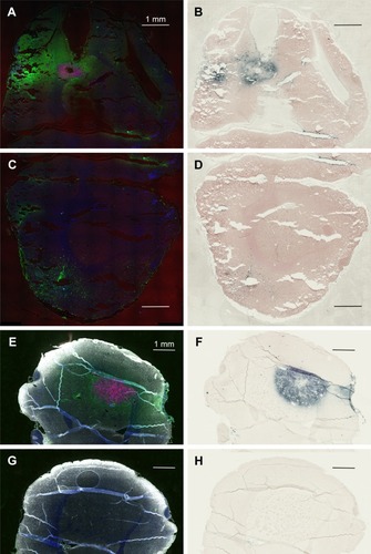 Figure 2 IV-injected AuNPs colocalize with F98 tumors. (A) Rat 1, left hemisphere, fluorescence; (B) Rat 1, left hemisphere, gold enhance; (C) Rat 1, right hemisphere, fluorescence; (D) Rat 1, right hemisphere, gold enhance; (E) Rat 2, left hemisphere, fluorescence; (F) Rat 2, left hemisphere, gold enhance; (G) Rat 2, right hemisphere, fluorescence; and (H) Rat 2, right hemisphere, gold enhance. (A–G) mCherry red (tumor, red), anti-albumin (edema, green), DAPI (nuclei, blue), and anti-CD31 (blood vessels, white) and (B–F) gold enhanced (gold stained, black).Abbreviations: AuNPs, gold nanoparticles; CD31, cluster of differentiation 31; IV, intravenous.