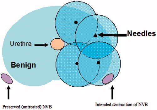 Figure 1. Transverse view of prostate showing cryo-needle configuration.