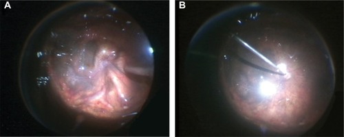 Figure 1 Photographs showing (A) temporary globe collapse under open-cannula conditions and (B) reinflation of the eye after non-valved cannulas are occupied while working under air.