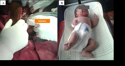 Figure 6 Fetal part (foot) seen upon entry to the abdominal cavity (A) and neonate with positional calcaneovalgus deformity (B).