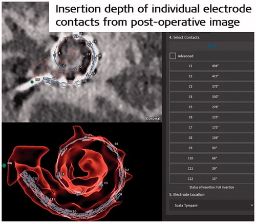 Figure 46. A screenshot from OTOPLAN® software that shows the identification of individual electrode channels, its corresponding angular insertion depth along with the centre frequency based on Greenwood’s function. Image courtesy of MED-EL.