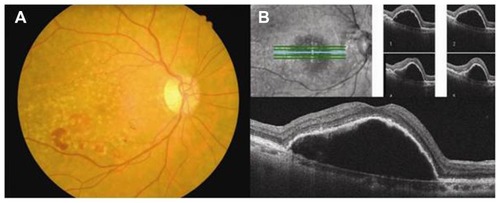 Figure 2 One month after the macular hole surgery. A fundus photograph of the right shows newly onset blot retinal hemorrhages (A). An optical coherence tomography image demonstrates dome-shaped retinal pigment epithelial detachment under the successfully sealed macular hole (B).