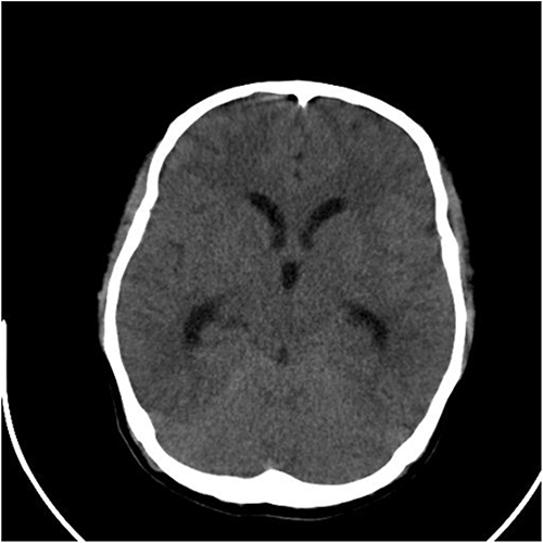 Figure 2 The initial computed tomography (CT) scan does not show any hydrocephalus and oedema.