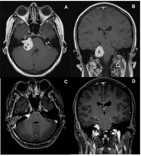 Figure 1 Contrast enhanced axial and coronal T1-weighted magnetic resonance images demonstrating a right sided vestibular schwannoma, pre-operatively (A and B) and post-operatively (C and D). Arrows demonstrate location of the VII/VIII nerve complex within the internal acoustic meatus of the contralateral, non-pathological side. The diameter of this tumour prior to resection was approximately 3cm and note that it has caused distortion of the right side of the pons.