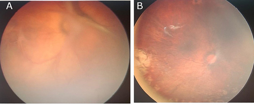 Figure 2 (A) Fundus view of the right eye showing Stage 4A ROP with VH threatening the macula. (B) Postoperative fundus photo showing flat retina without evidence of traction and peripheral endo-laser and regressed disease.