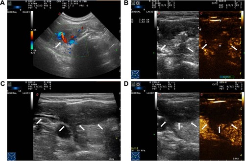 Figure 3 (A) Active bleeding lesion was detected along with small bleeding vessels leaking to the thyroid surface (arrowhead). (B) Contrast-enhanced sonography showed an irregular hematoma measuring 2.6×1.6 cm around the right thyroid (arrowheads). (C and D) Irregular hematoma was detected around the right thyroid, and ablation region showed no enhancement on contrast-enhanced sonography (arrowheads).