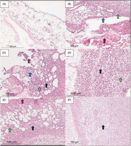 Figure 9. Rat skin samples after the six-day treatment. (A) The normal skin control group showed intact skin surface epithelium and normal dermal and subcutaneous tissues without inflammation (H&E, ×100). (B) Group 1 – no treatment: wide ulceration of the surface (blue arrow) covered by an excessive amount of fibrinoid material (red arrow). The dermis and the subcutaneous tissue show mixed acute and chronic inflammatory cells (green arrow), H&E ×200. (C) Group 2 – cinnamon oil gel: smaller skin ulcers (blue arrow) covered by fibrinoid material (red arrow). The dermis and subcutaneous tissue show inflammatory infiltrate (green arrow) and fibrosis (black arrow) H&E ×200. (D) Group 3 – NLC-cinnamon oil colloid: wide areas of granulation tissue (green arrow) admixed with fibrosis denoting the healing process (black arrow) H&E ×200. (E) Group 4 – NLC blank gel: focal ulcerated area covered by fibrinoid material (red arrow) with small areas of granulation tissue and fibrosis (black arrow) extending to the dermis and subcutaneous tissue with moderate mixed acute and chronic inflammatory infiltrate (green arrow), H&E ×200. (F) Group 5 – NLC-cinnamon oil gel: wide areas of granulation tissue and fibrosis occupying the whole dermis (black arrow), H&E ×200.