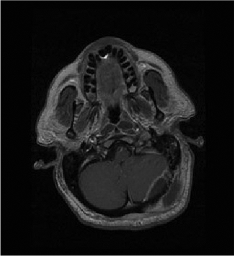 Figure 2c. TI axial post gadolinium image demonstrating a ring-enhancing lesion of left suboccipital soft tissue and posterior fossa epidural space consistent with abscess.