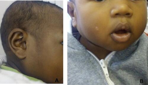 Figure 3 Marked reduction of parotid hemangioma after 10 months of oral propranolol: (A) right profile; (B) front view.