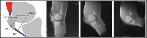Figure 1. Knee model and MRI scans.
