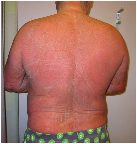 Figure 2 Patient with Sézary syndrome presenting clinically with generalized erythroderma and thickening (lichenification) of the skin.