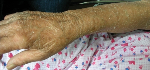 Figure 1 The color photograph shows the scaling and the dryness on the skin of arm.