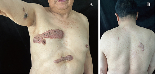 Figure 1 Dermatomal distribution of keloids at the site of healed herpes zoster. (A) The patient had multiple plaques in the right trunk and arm, corresponding to dermatomes T2–T3 and T7, with the largest located in the right chest T2-T3 dermatome, measuring 19 cm (L) × 5 cm (W); (B) The patient had a right dorsal plaque, not beyond the midline.