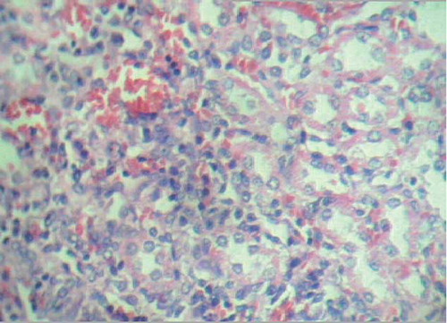 Figure 5. Proliferation of tubular epithelial cells, regenerative changes, and moderate intertubular hemorrhage (H&E staining, ×280).