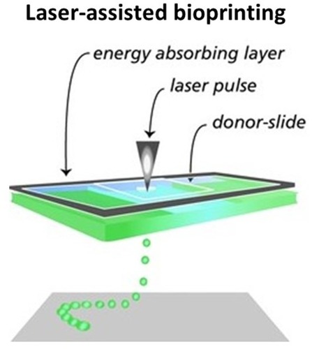 Figure 2 Adapted with permission from Malda J et al. 25th Anniversary Article: Engineering Hydrogels for Biofabrication. Adv Mater. 2013;25(36):5011–5028. © 2013 WILEY‐VCH Verlag GmbH & Co. KGaA, Weinheim; showing the principle of a laser-assisted bioprinter.Citation27