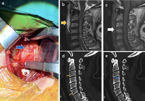 Figure 4 (a) Intraoperative exploration showed ALL damage in C3/4 (blue arrow). (b) the area of T2HS was 6.245cm² (yellow arrow). (c) The prevertebral low signal intensity of the C3/4 segment pointed to by the white arrow was interrupted. (d) The yellow lines represent the thickness of prevertebral soft tissue. The TOPST of C3 and C6 was 0.89 and 1.02cm. (e) The IDA of C3/4 in this patient was 13.814°(blue line).