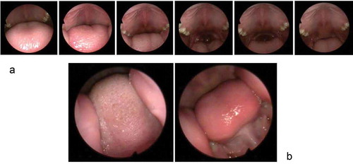 Figure 3. The oral cavity during DPI use of a child. a: Captures from a video recording of the changes in the passageway for the aerosol during a single inhalation manoeuvre; b; examples of a narrowed passageway by elevated tongue and inwards directed displacement of the cheeks (captures from different video recordings of different children showing some extreme situations). The recordings were made using a bronchoscope in the mouthpiece of a test inhaler with exchangeable mouthpieces and air flow resistances [Citation150].