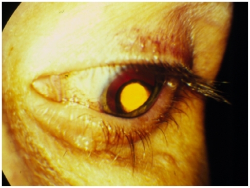 Figure 4 Sustained-release ganciclovir implant sutured to the pars plana as seen through the pupil.
