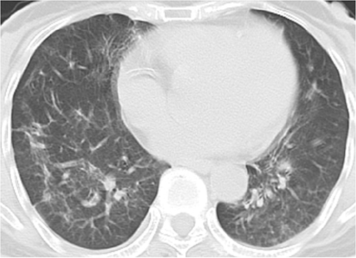 Figure 4 Chest CT scan at the time of discharge for this case. Bilateral pulmonary inflammation shows significant absorption, with minimal pleural effusion observed bilaterally.