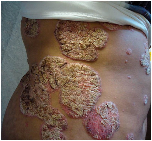 Figure 3. Before treatment with ustekinumab.