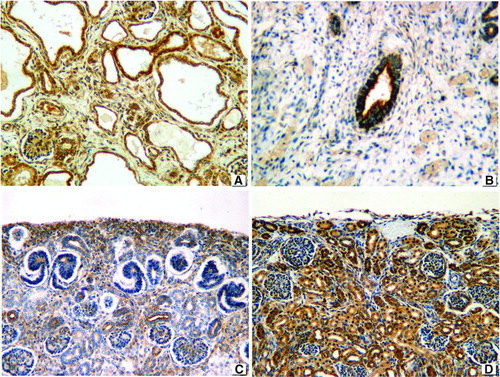 FIGURE 6  IGF2 expression in (A) obstructive MCDK depicts strongly positive membranous and cytoplasmic staining. (B) Weaker membranous expression in non-obstructive MCDK. (C) Positive staining in nephrogenic zone of preterm kidney. (D) Positive normal control. 76 × 57 mm.