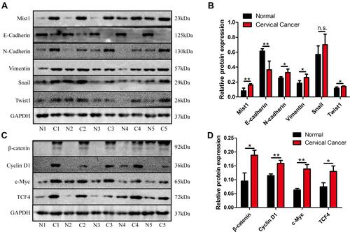 Figure 4 The relationship between Mist1 and EMT markers and Wnt signaling pathway in patients with cervical cancer. (A) The protein expression of Mist1, E-cadherin, N-cadherin, Snail, Vimentin and Twist was measured by the Western blot analysis. (B) Quantification of Mist1, E-cadherin, N-cadherin, Snail, Vimentin and Twist protein expression in patients with cervical cancer. (C) The protein expression of β-catenin, cyclin D1, c-Myc and TCF4 was measured by the Western blot analysis. (D) Quantification of β-catenin, cyclin D1, c-Myc and TCF4 protein expression in patients with cervical cancer. *P <0.05, **P<0.01.