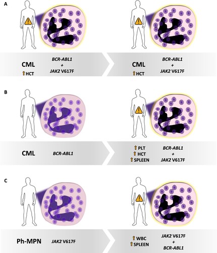 Figure 1. Different possible scenarios of BCR-ABL1 and JAK2 (V617F) co-occurrence in MPNs. (A) A CML patient can show the JAK2 mutation at diagnosis and present a ‘hybrid’ phenotype. (B) A CML patient can acquire the JAK2 mutation during follow-up, together with a phenotype change. (C) A JAK2 mutated Ph-MPN can acquire BCR-ABL1 during follow-up and change the phenotype. CML: chronic myeloid leukemia; Ph-MPN: Philadelphia-negative myeloproliferative neoplasm; PLT: platelets; HCT: hematocrit; WBC: white blood cells.