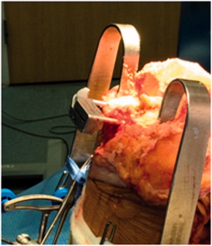 Figure 5. Cut-guide placement based on intra-op plan after the bone cuts.