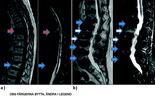 Figure 2. MRI examples for single acute, concomitant, and previous vertebral fractures. a. Patient no. 1 with T1w and STIR images. b. Patient no. 2 with T2w and STIR images. Blue arrow: single acute fracture; red arrow: previous fracture; white arrow: concomitant fracture.