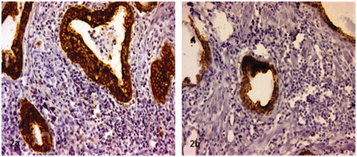 Figure 2. Strong positive SP-A (a) and SP-D (b) immunostaining particularly in inflammatory sites of non-malignant prostate tissue specimens. Note: Original magnifications for the images was 200×.