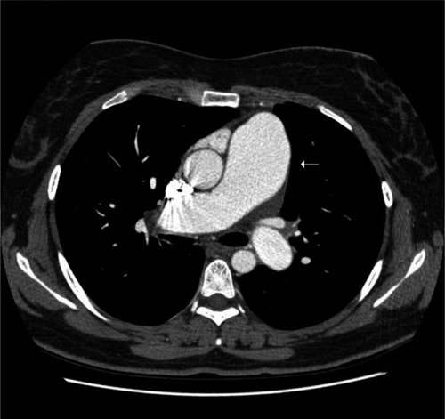 Figure 1 Computed tomography thorax reveals marked enlargement of pulmonary artery (arrow).