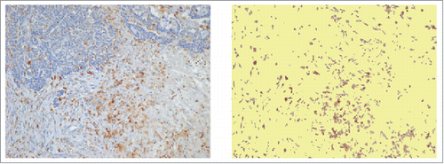 Figure 5. Capture of immune reactive areas at image analysis. Example of computer assisted selection of immune reactive areas spots by red green and blue (RGB) color segmentation of the original digital microphotograph. Immune-reactive area, brown. Not stained tissue, yellow. The percent ratio between immune reactive areas and total area was automatically calculated.