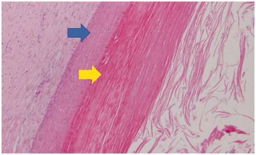 Figure 4. Histopathological findings (hematoxylin-eosin staining, original magnification × 100) upper arrow: squamous epithelium lining, lower arrow: keratin collections. The cyst wall was composed of stratified squamous epithelium with abundant keratin. There were no hair tissue structures or atypical cells.
