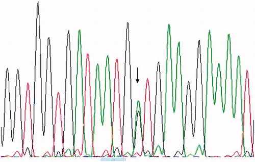 Figure 1. Sanger sequence profile shows the heterozygous A/G transition point mutation in codon M694V of exon 10 in MEFV gene (arrow) in one of the CRF cases that require long-term hemodialysis.