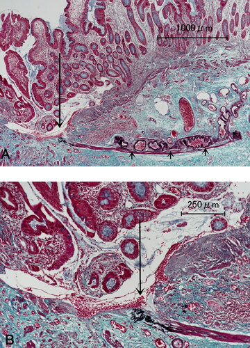 Figure 2. Photomicrographs of case 2. (A) Elastica-Masson staining exhibits submucosal tortuous arterioles (short arrows) and DL (long arrow). (B) High magnification indicates ruptured arteriole (arrow).