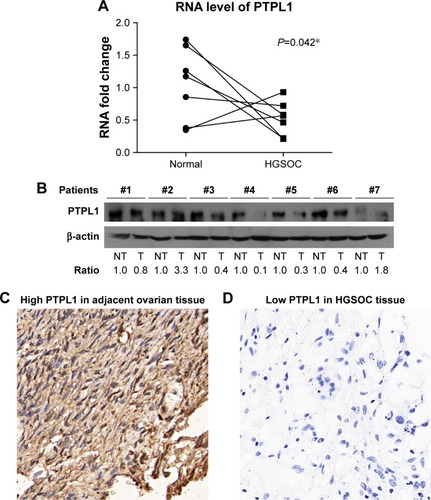 Figure 1 Expression patterns and cellular localization of PTPL1 in ovarian carcinoma tissues and normal ovarian tissues.