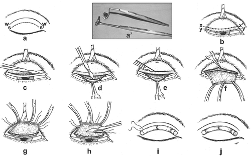 Figure 1. Schema of surgical technique of ptosis correction with MT flap resection. (a') Author’s minor modification of Desmarres retractor for ergonomic conveniences; (a) line w–w′ – orbital sulcus, s–s′ line for formation of skin fold; (b) cautery applied along dotted points of lines x-x' and y-y'; (c) for creation of conjunctival flap, button hole line y-y' and cut along the line with Vannas scissors, and; (d) snip off Müller muscle fibres from conjunctiva; (e) along line x-x' a deep groove is carved with # 15 blade, the centre 4mm of the groove is button holed, and the tarsus cut along the groove with Vannas scissors, to create the MT flap; (f) mobilised MT flap after severance of medial and lateral horns of aponeurosis for resections exceeding 12 mm; (g) double armed sutures coapting conjunctival flap and levator; (h) resection of MT flap distal to sutures; (i-j) sutures being tied onto the bolster.