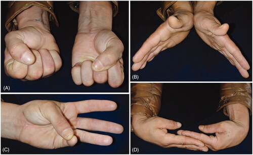 Figure 5. Clinical photographs two years after surgery showing good functional recovery.