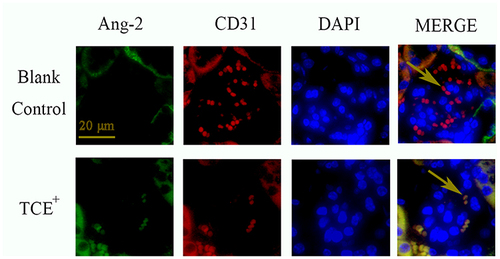 Figure 17 The location of Ang-2 (×400). Ang-2 was mainly expressed on endothelial cells. Yellow arrow: endothelial cells.