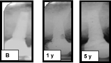 Figure 2. Radiographical results of the right side of the patient (PRP/DBBM side) at baseline (B), 1 and 5 years.