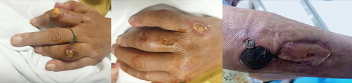 Figure 6 Patient’s skin condition on 2023-07-25.