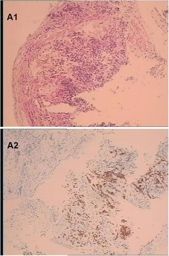 Figure 3 (A1 and A2) The result of the lump in the left lung pathological histopathology and immunohistochemistry by local bronchoscopy biopsy performed showed that is small-cell endocrine cancer.