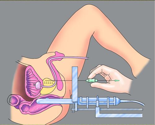 Figure 1 Transperineal template biopsy with brachytherapy grid. Image courtesy from BXTA.