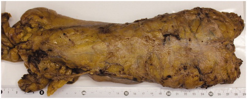 Figure 2. Specimen of the rectum with tumor after the total mesorectal excision with complete TME.