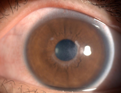 Figure 7 One month after the operation, the left eye infection was under control, and the nubecula remained in the center of the cornea.