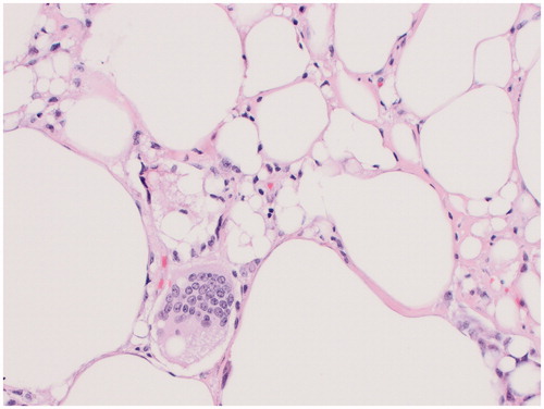 Figure 5. This image shows vacuolated histiocytes and a foreign body-type giant cell, features of the silicone granuloma taken from the lesion on the external surface of the right capsule.